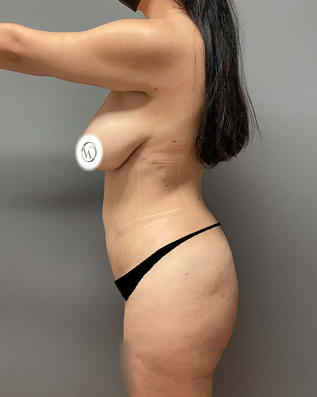 Brazilian Butt Lift Before & After Image
