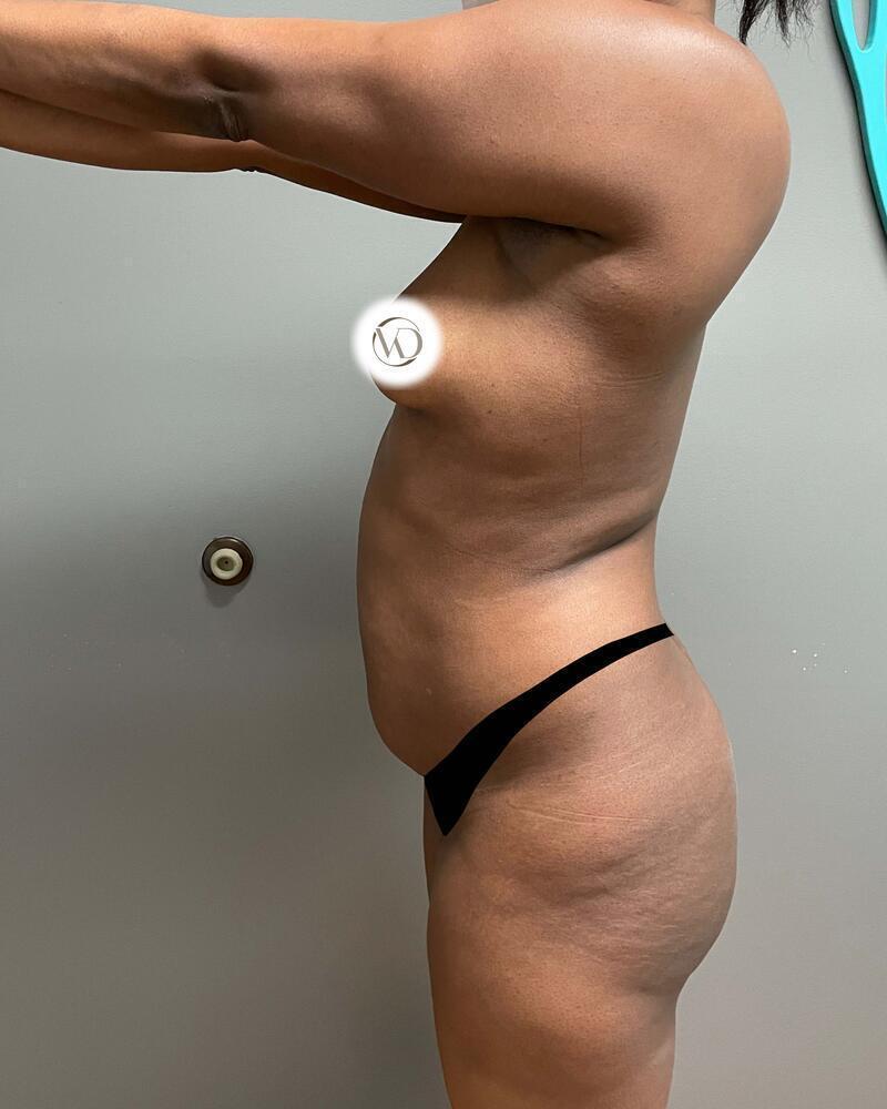 Brazilian Butt Lift Before & After Image