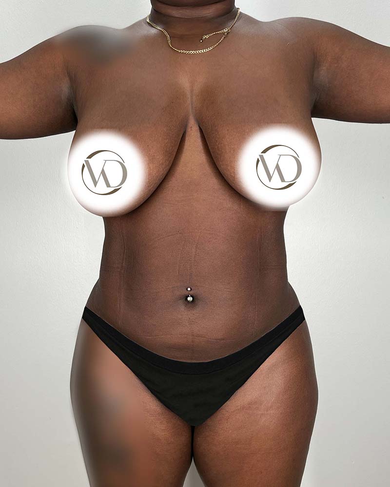 Brazilian Butt Lift Before & After Image
