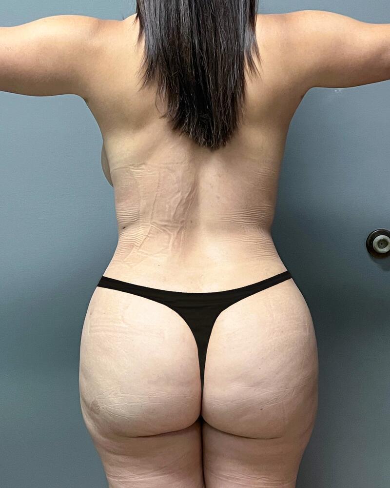 Sculptra Before & After Image