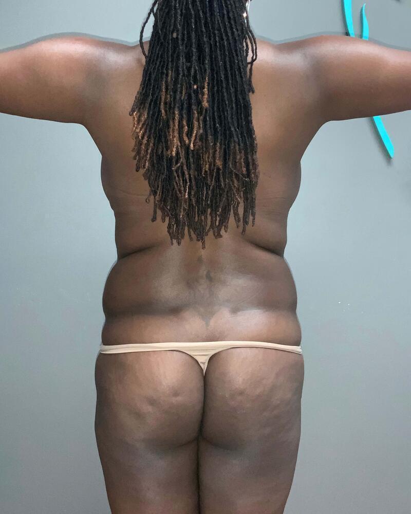 Brazilian Butt Lift Before & After Image