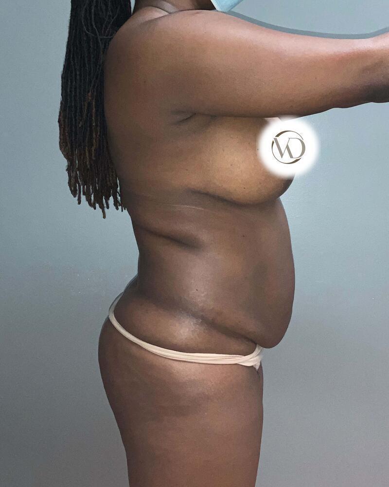 Brazilian Butt Lift Before & After Image