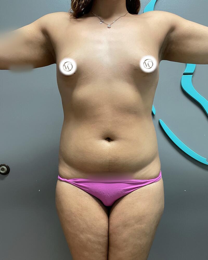 Fat Grafting to Hips Before & After Image