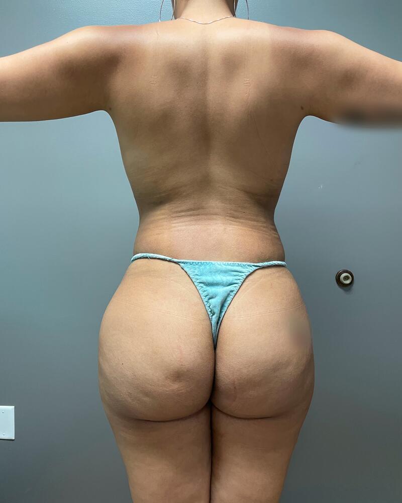 Fat Grafting to Hips Before & After Image