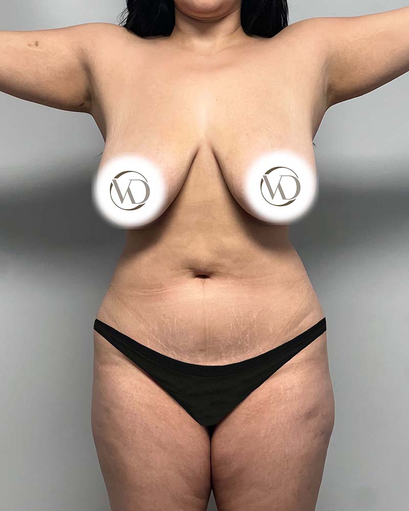 Fat Grafting to Hips Before & After Image