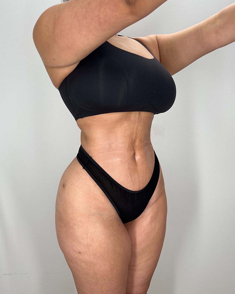 Fat Grafting to Hips Before & After Image