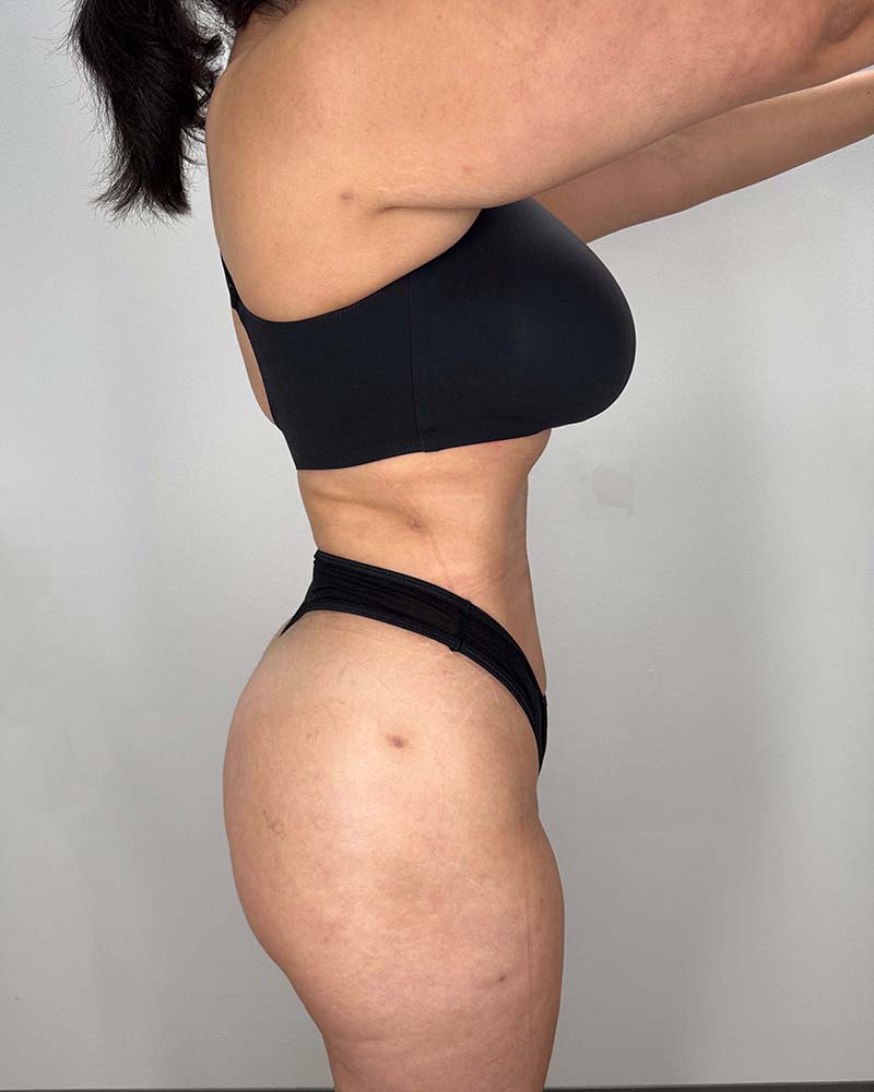 Fat Grafting to Hips Before & After Image