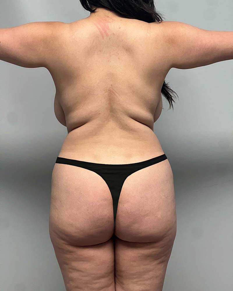 Fat Grafting to Hips Before & After Image