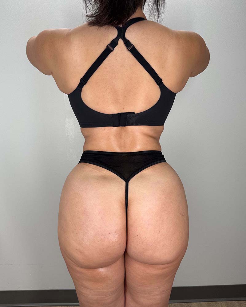 Fat Grafting to Hips Before & After Image