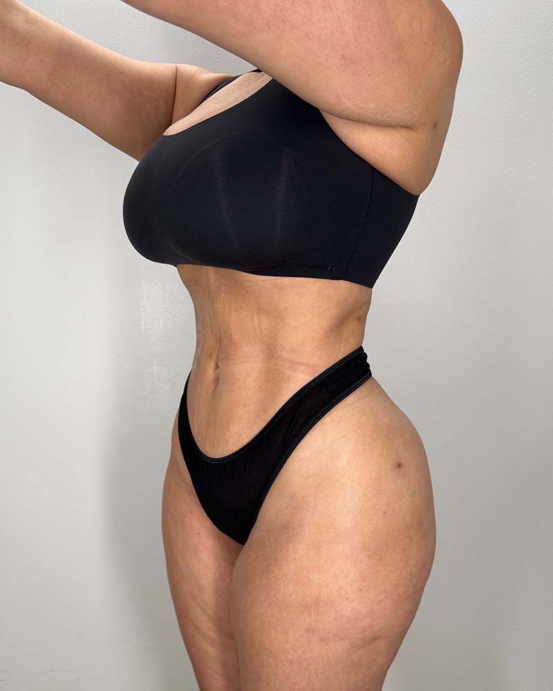 Fat Grafting to Hips Before & After Image
