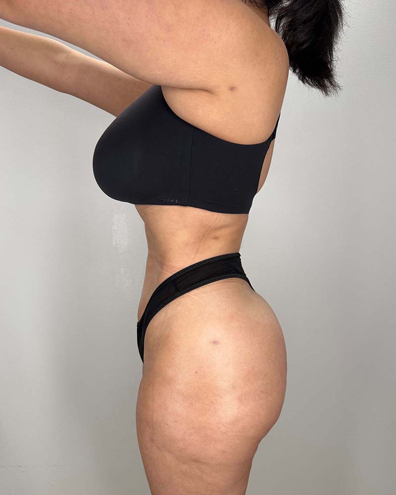 Fat Grafting to Hips Before & After Image