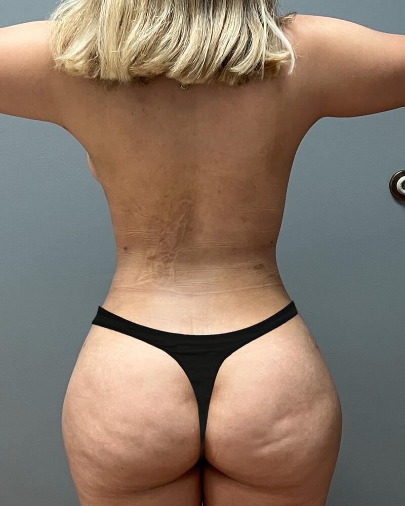 Sculptra Before & After Image