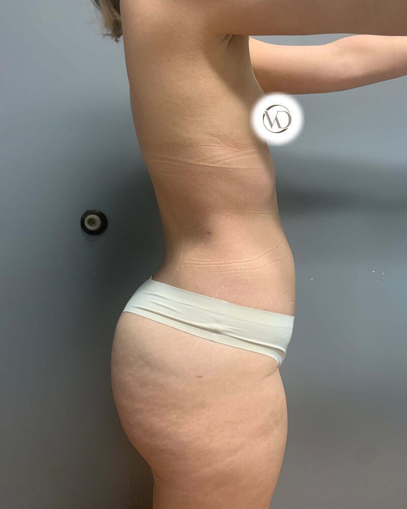 Fat Transfer Before & After Image