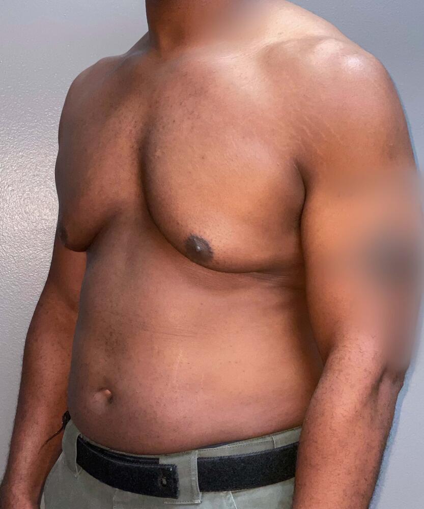 Gynecomastectomy Before & After Image