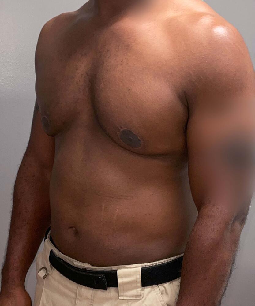 Gynecomastectomy Before & After Image