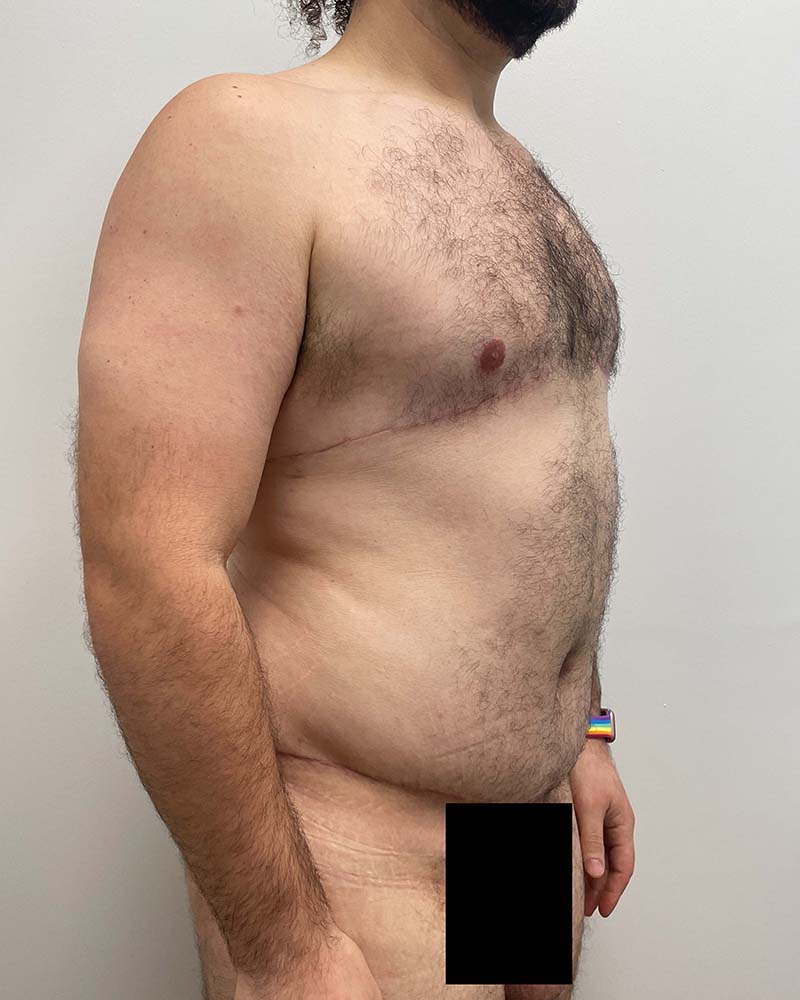 Gynecomastectomy Before & After Image