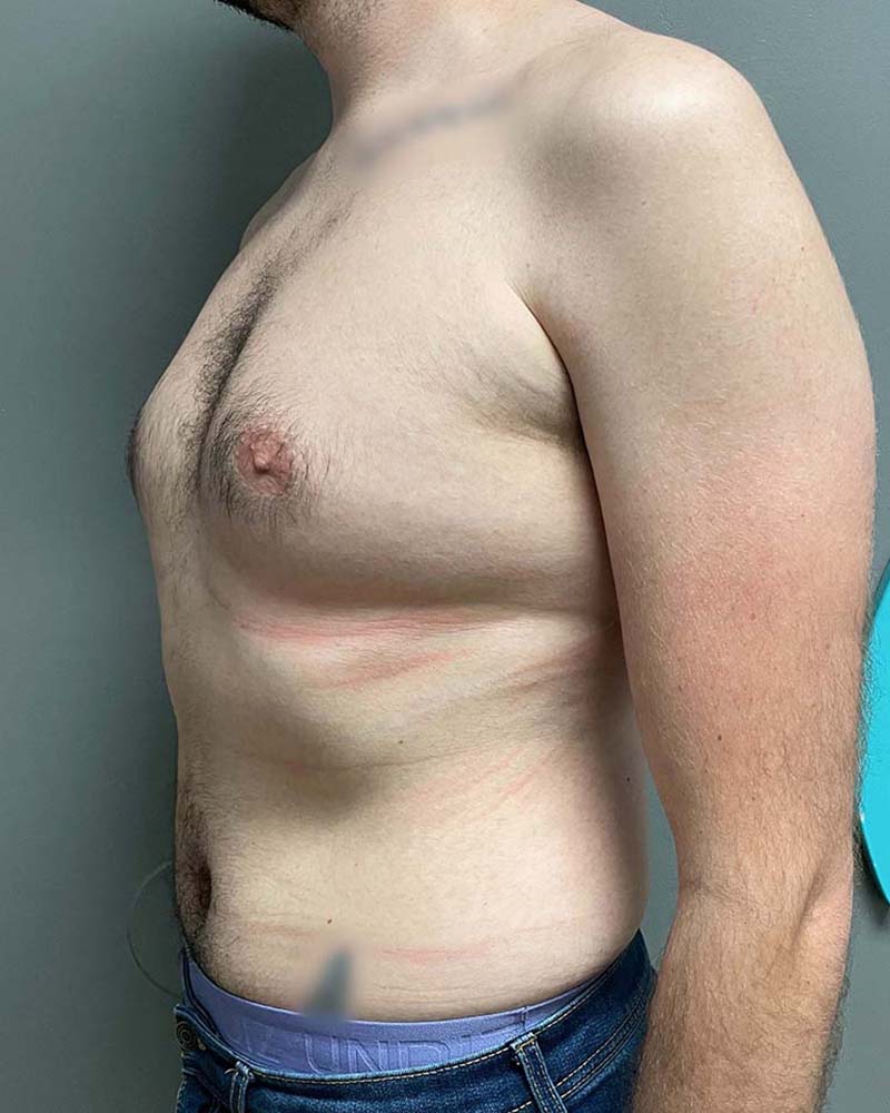 Gynecomastectomy Before & After Image