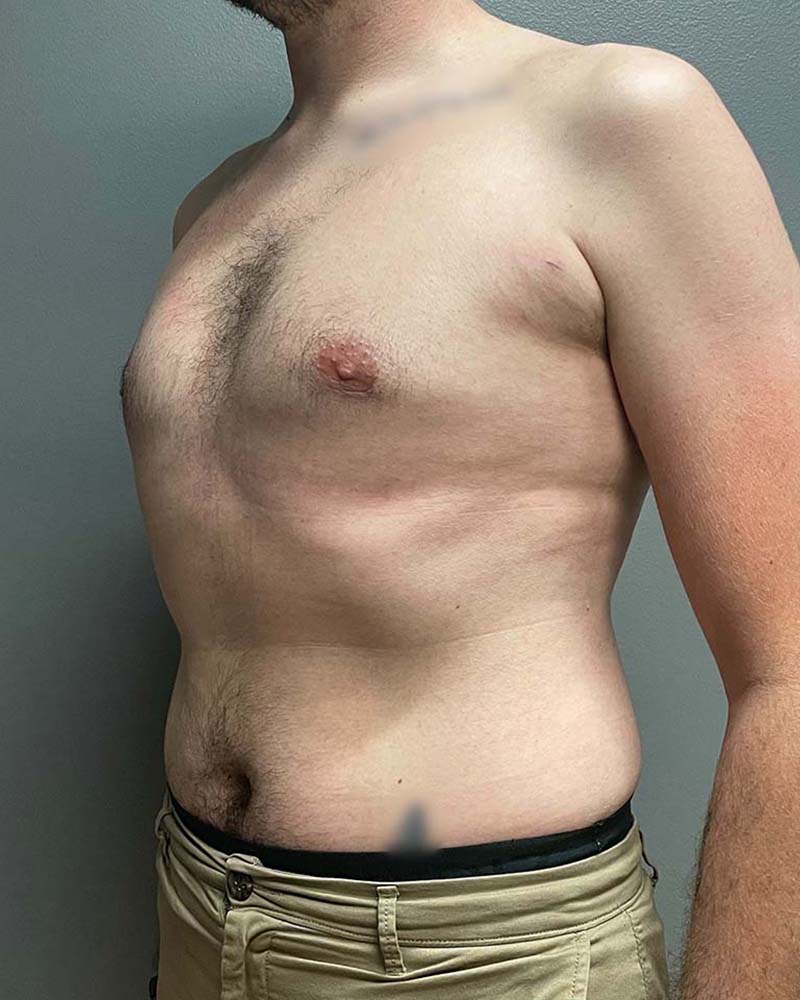 Gynecomastectomy Before & After Image