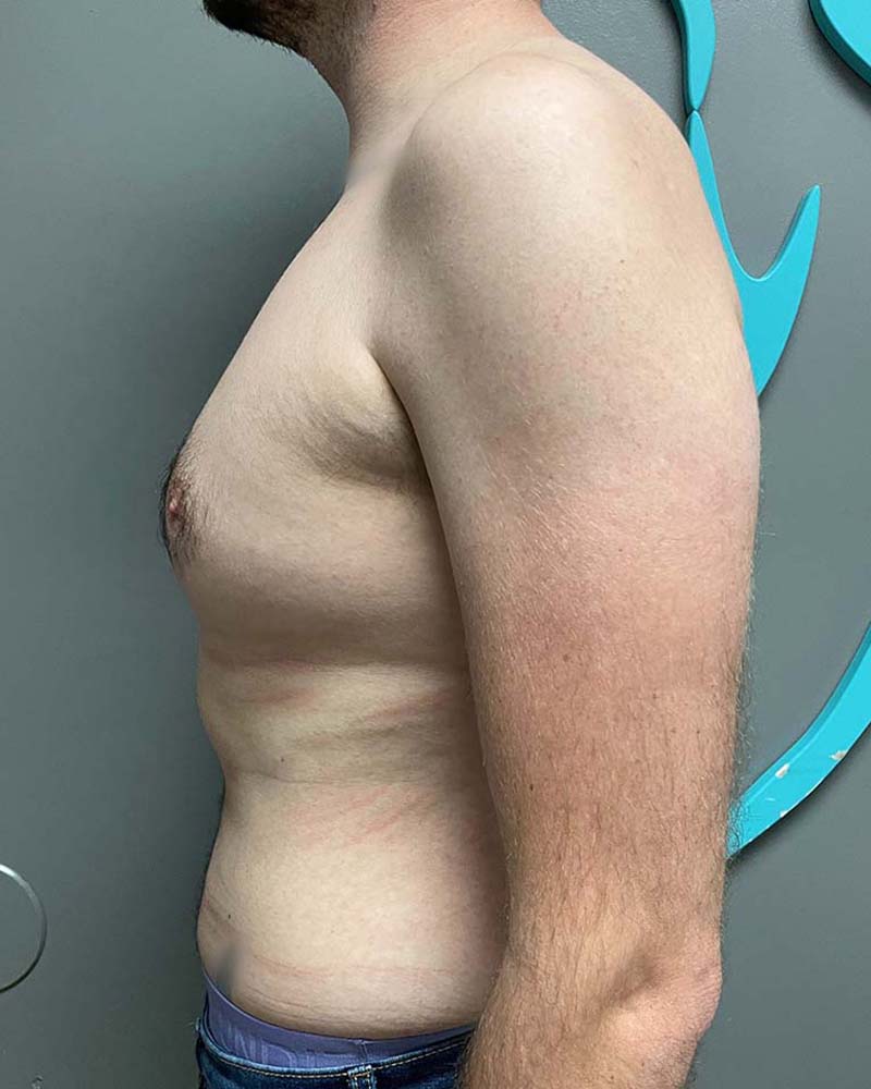 Gynecomastectomy Before & After Image