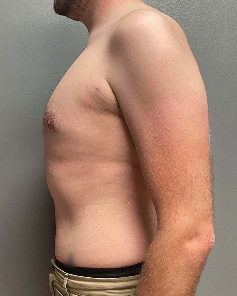 Gynecomastectomy Before & After Image