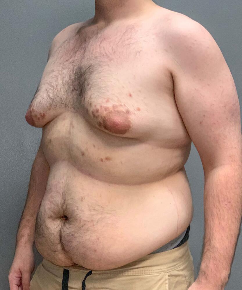 Gynecomastectomy Before & After Image