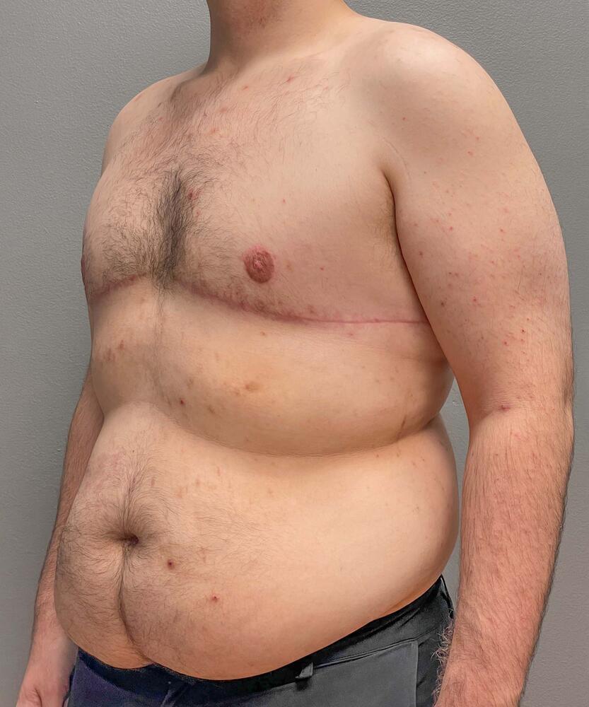 Gynecomastectomy Before & After Image