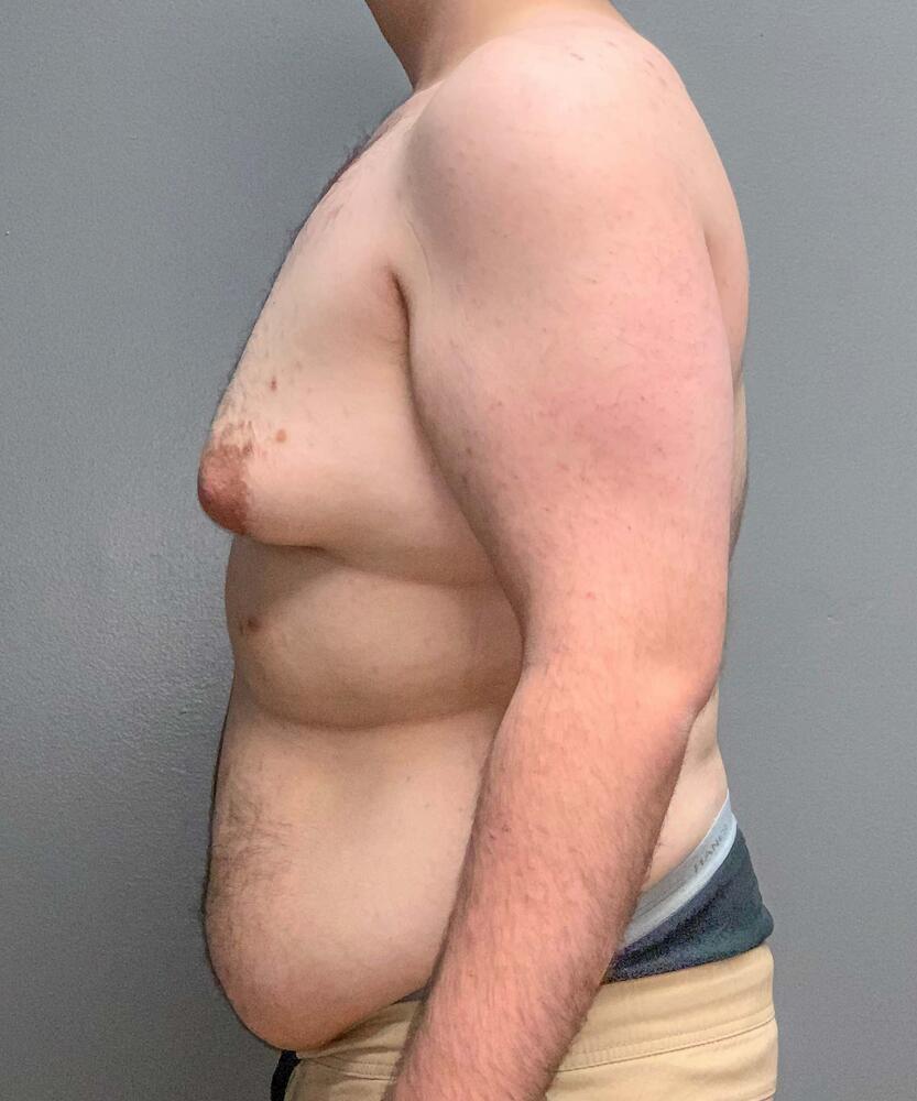 Gynecomastectomy Before & After Image