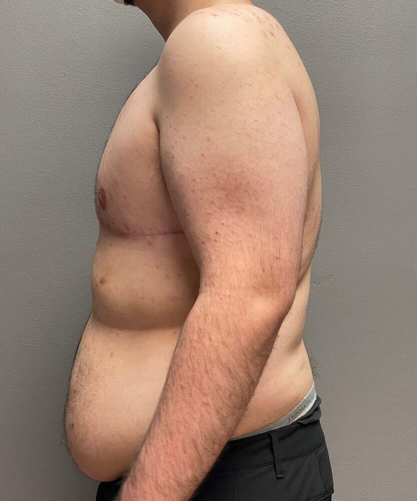 Gynecomastectomy Before & After Image