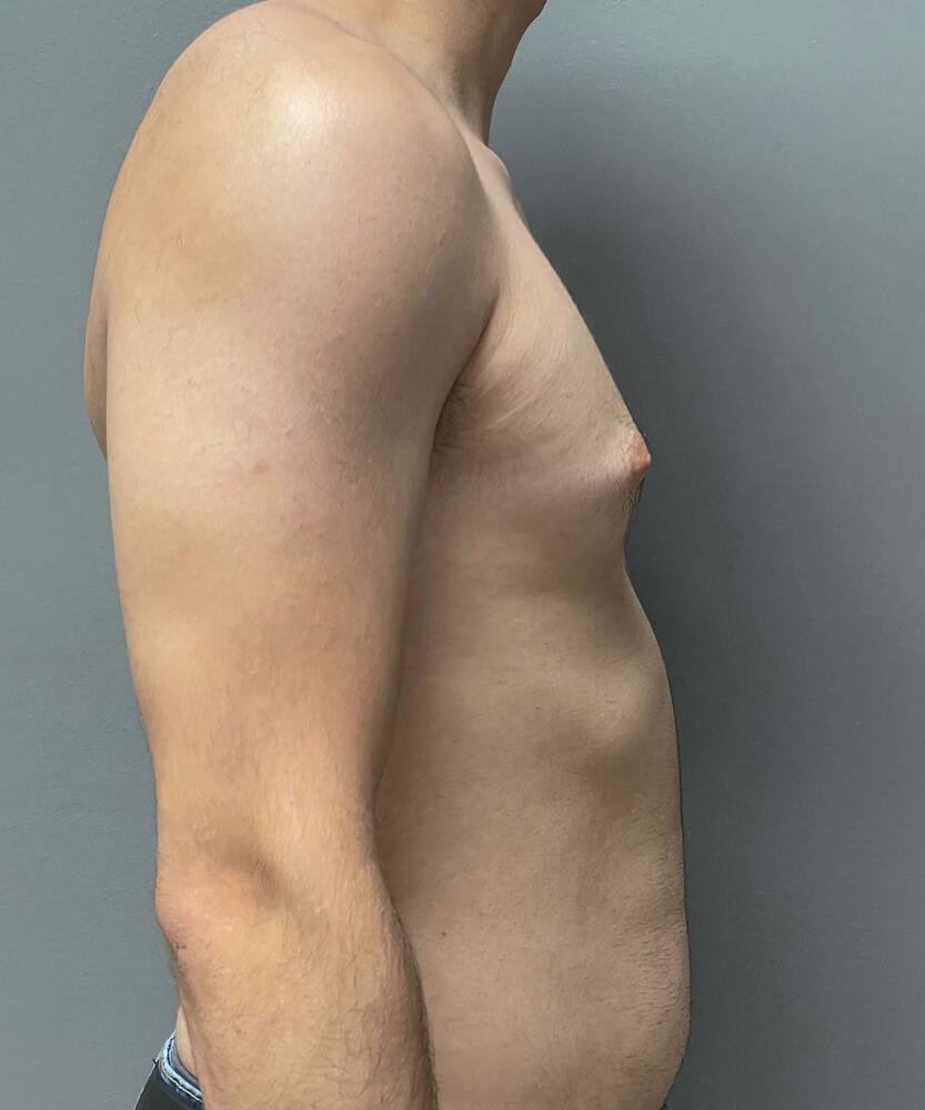Gynecomastectomy Before & After Image
