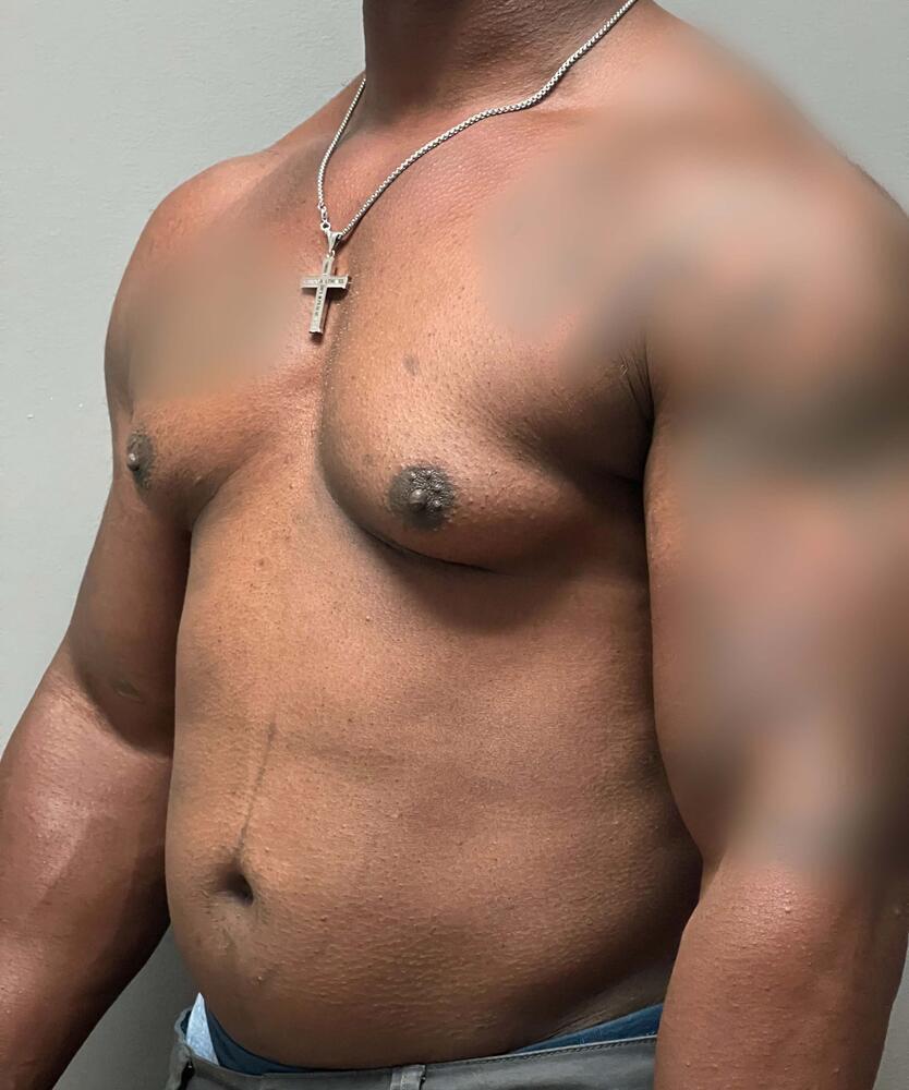 Gynecomastectomy Before & After Image