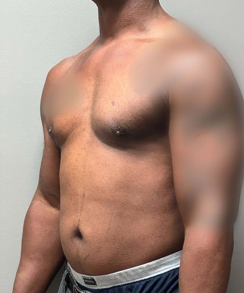 Gynecomastectomy Before & After Image