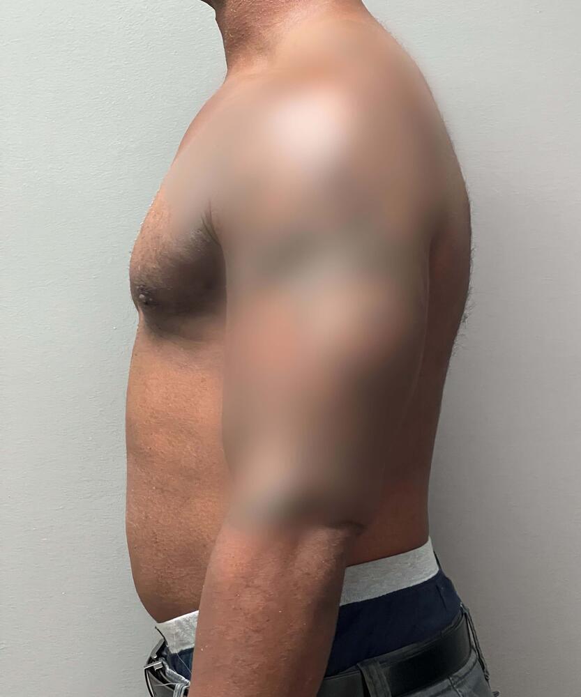 Gynecomastectomy Before & After Image