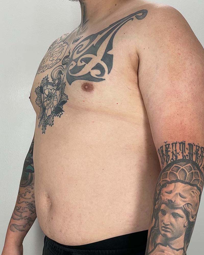 Gynecomastectomy Before & After Image