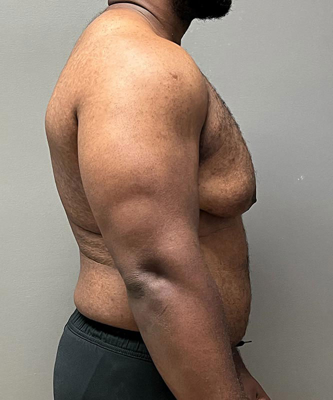 Gynecomastectomy Before & After Image