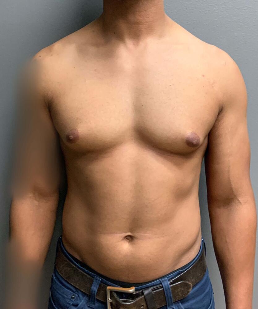 Gynecomastectomy Before & After Image