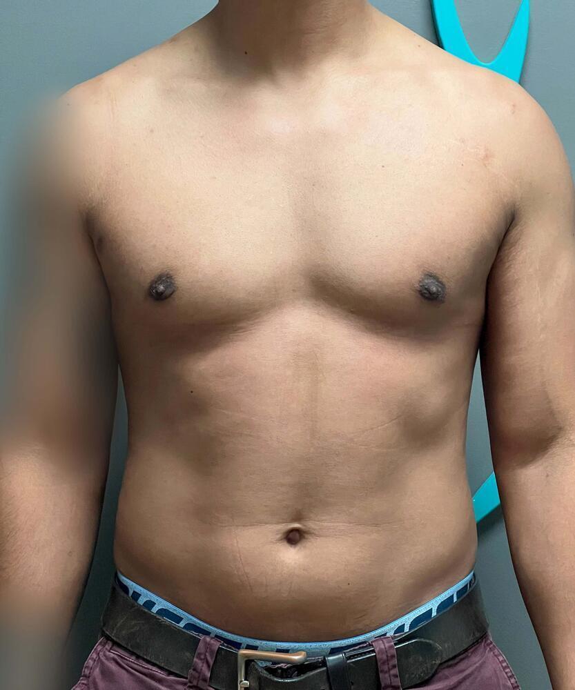 Gynecomastectomy Before & After Image