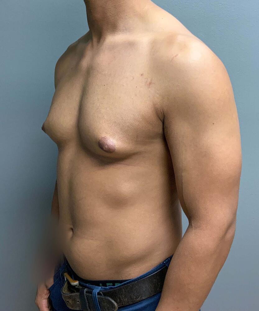 Gynecomastectomy Before & After Image
