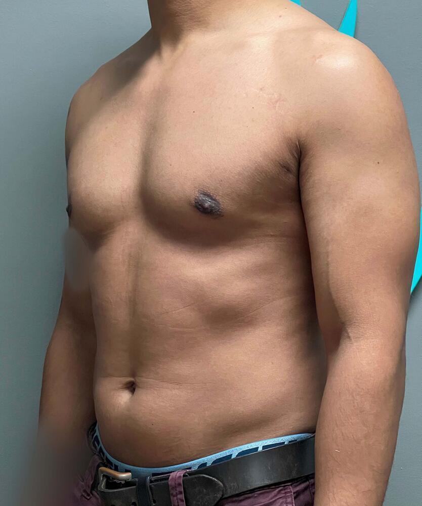 Gynecomastectomy Before & After Image