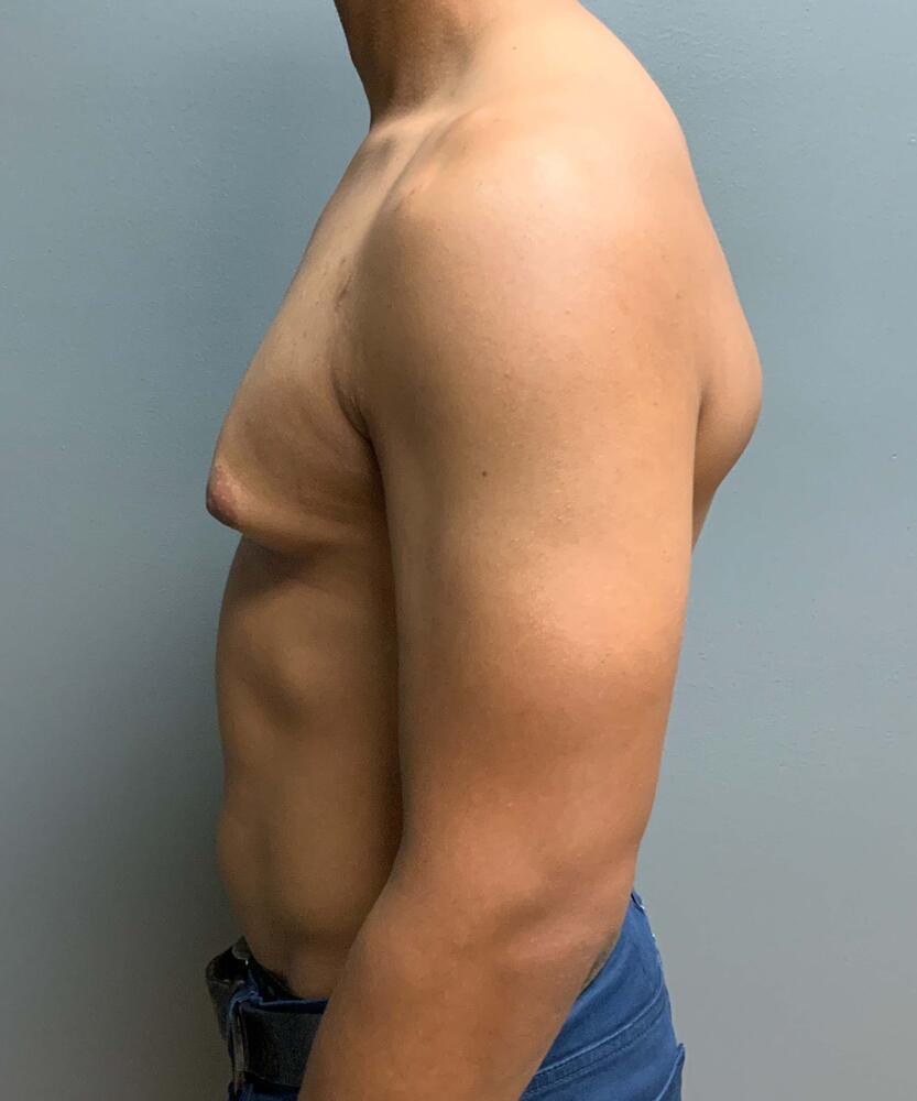 Gynecomastectomy Before & After Image
