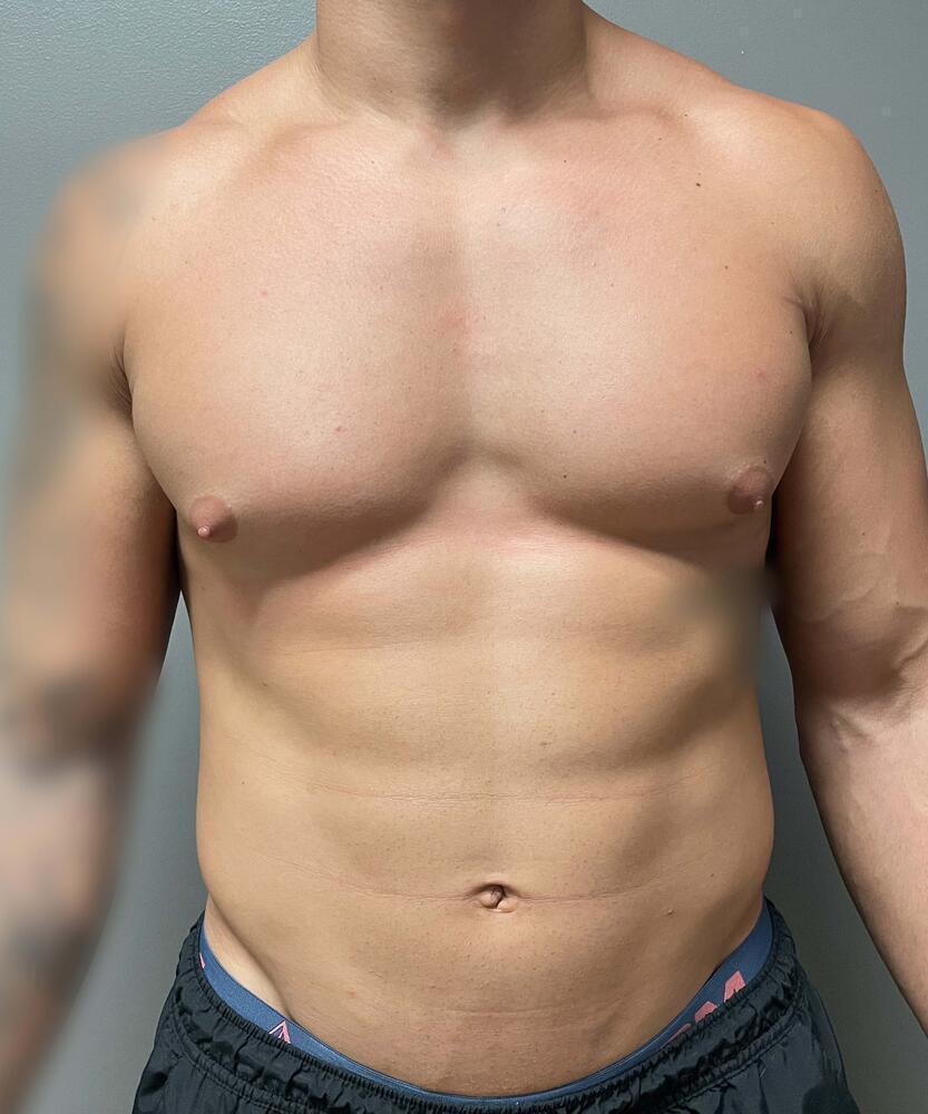 Gynecomastectomy Before & After Image