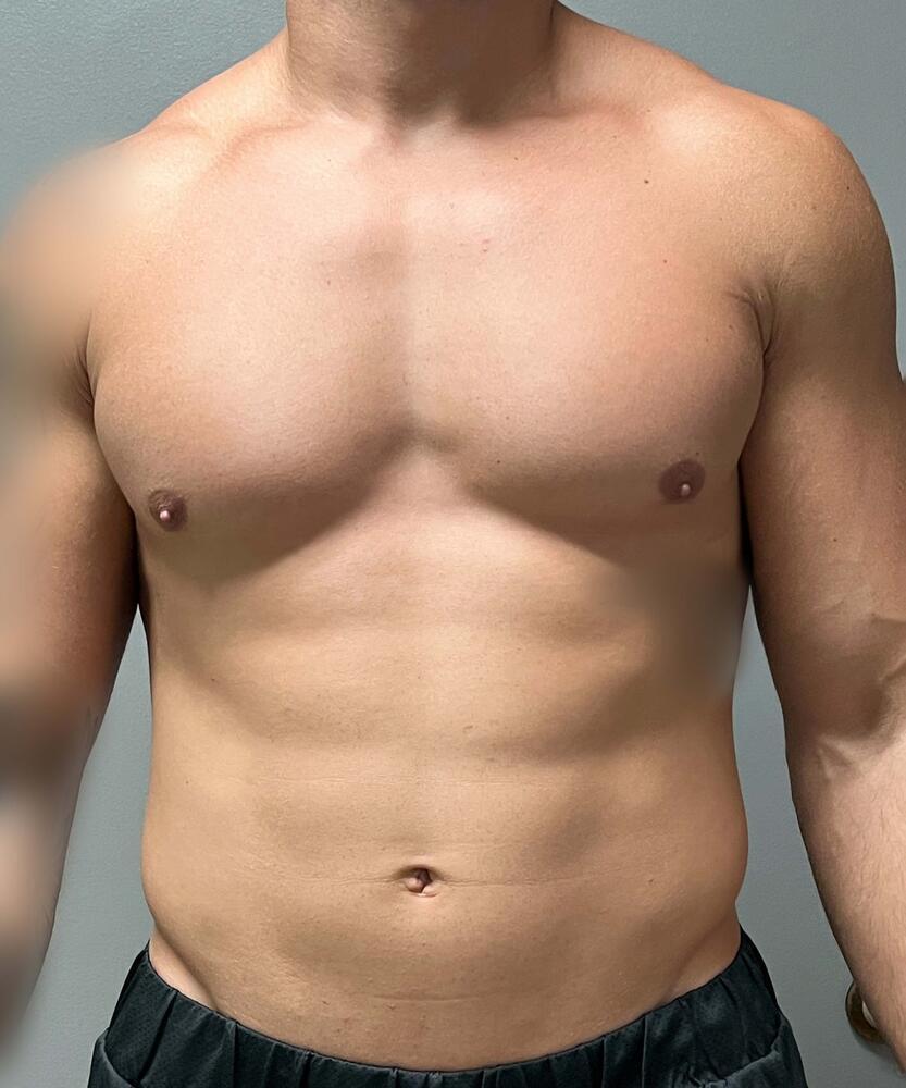 Gynecomastectomy Before & After Image