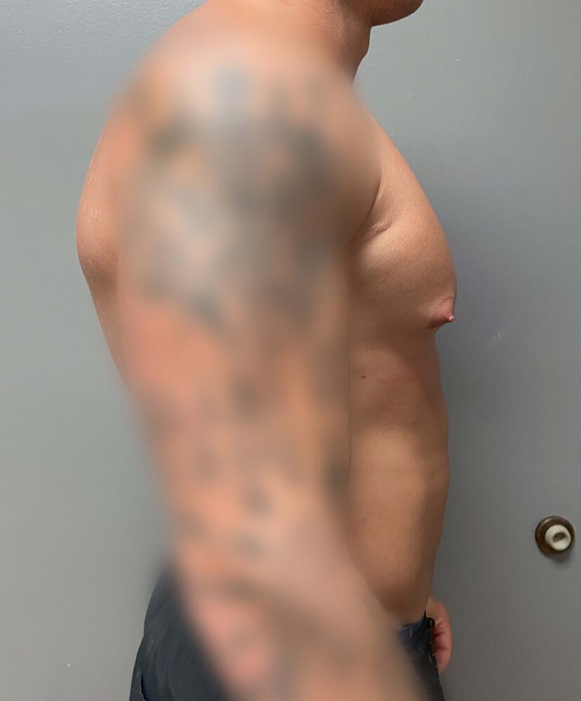 Gynecomastectomy Before & After Image