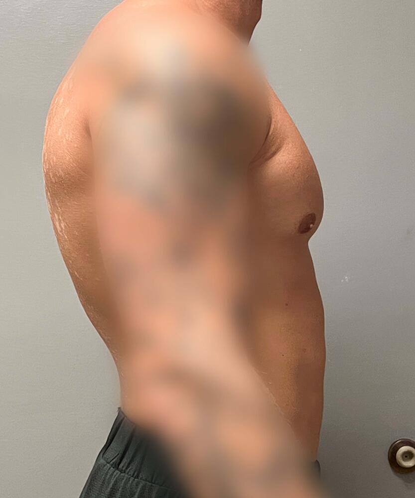 Gynecomastectomy Before & After Image