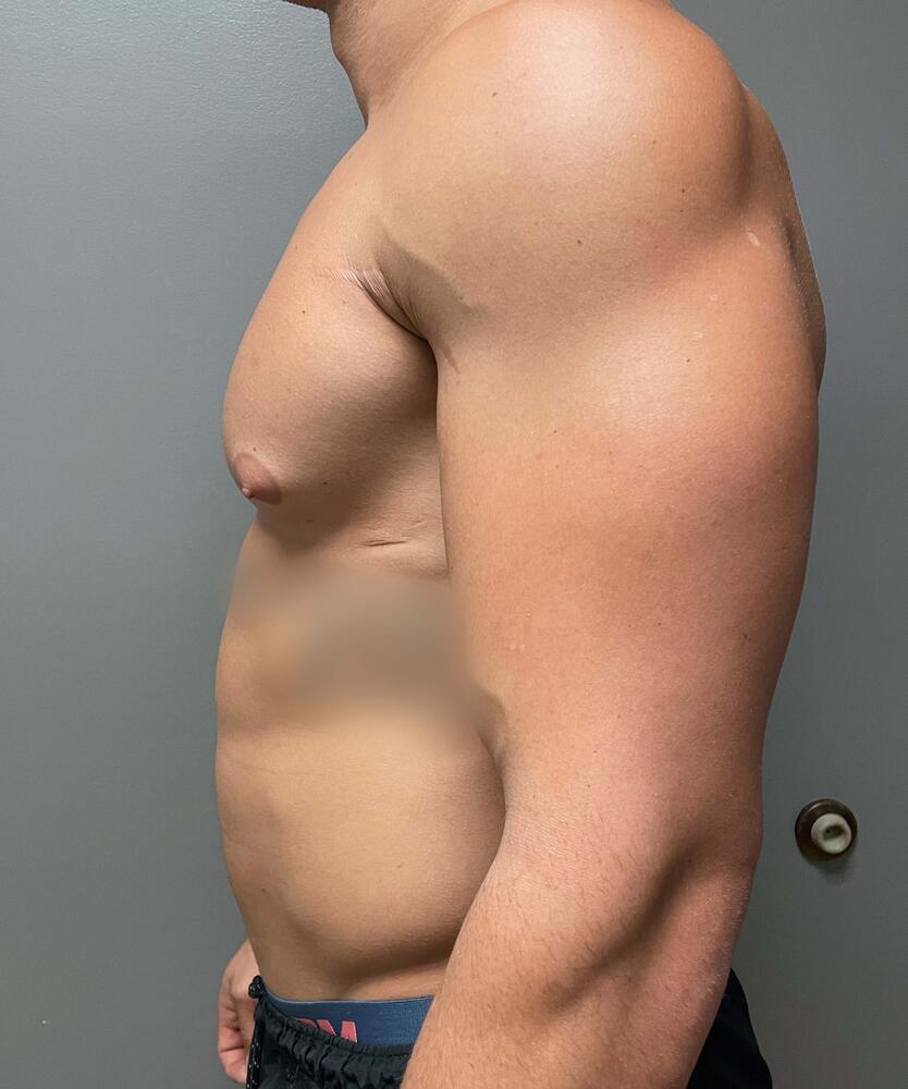 Gynecomastectomy Before & After Image