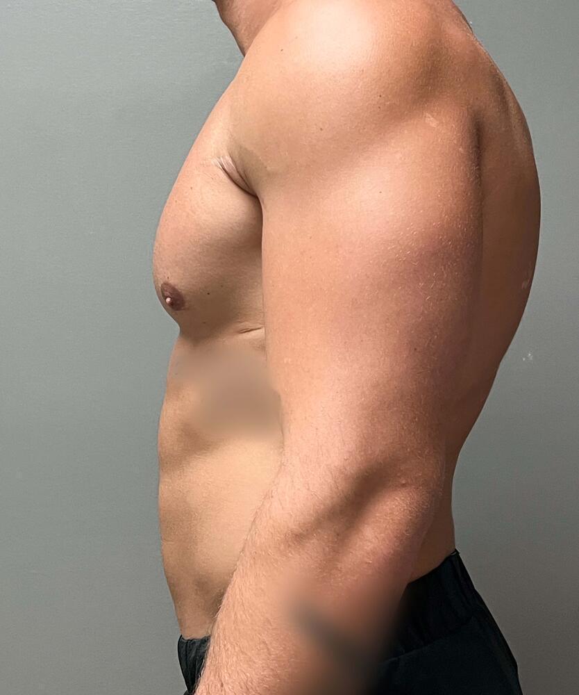 Gynecomastectomy Before & After Image