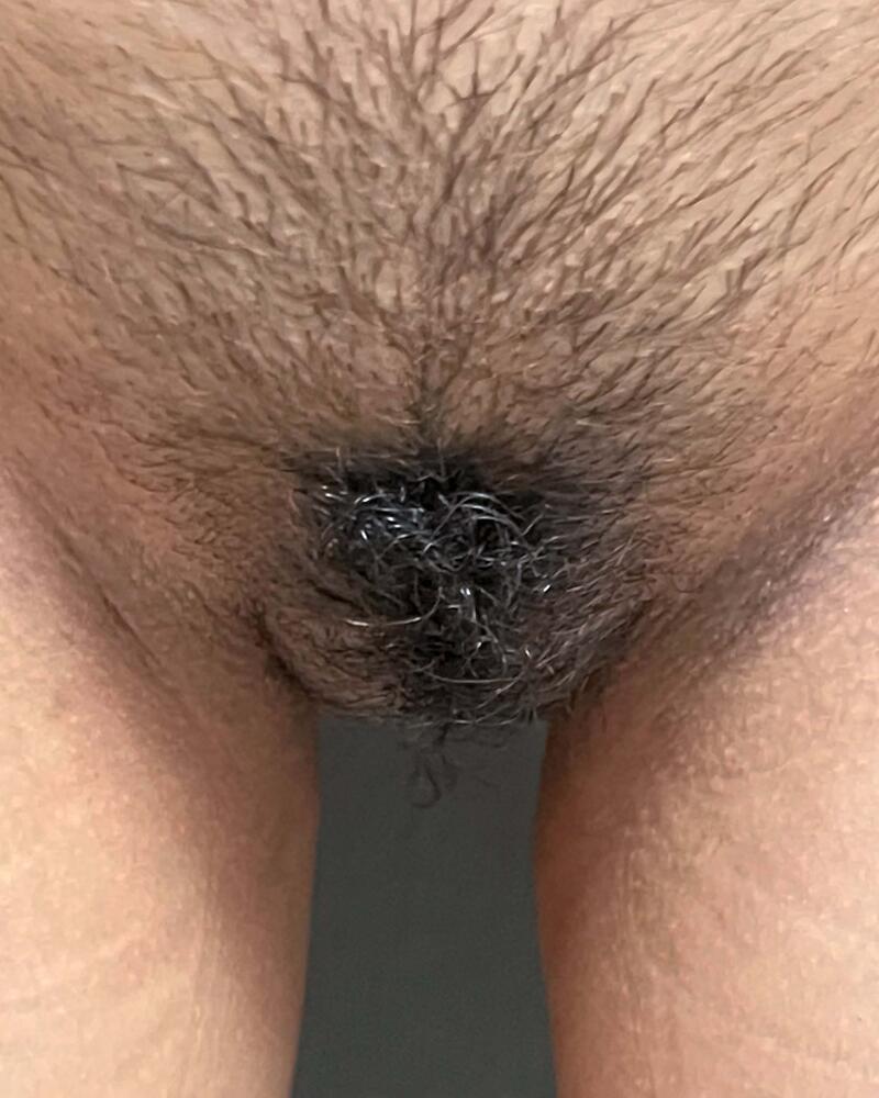 Labiaplasty Before & After Image