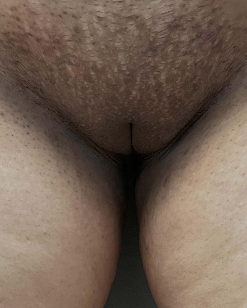 Labiaplasty Before & After Image