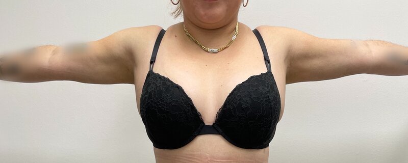 Liposuction Arms Before & After Image