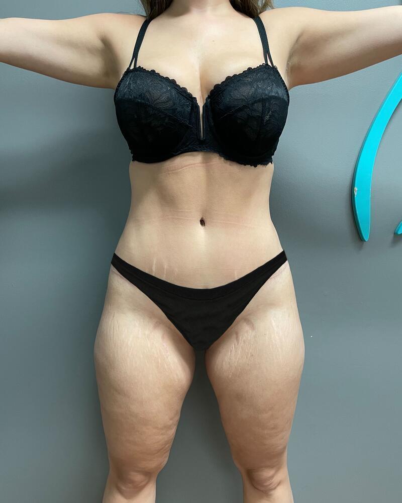 Liposuction Knees Before & After Image
