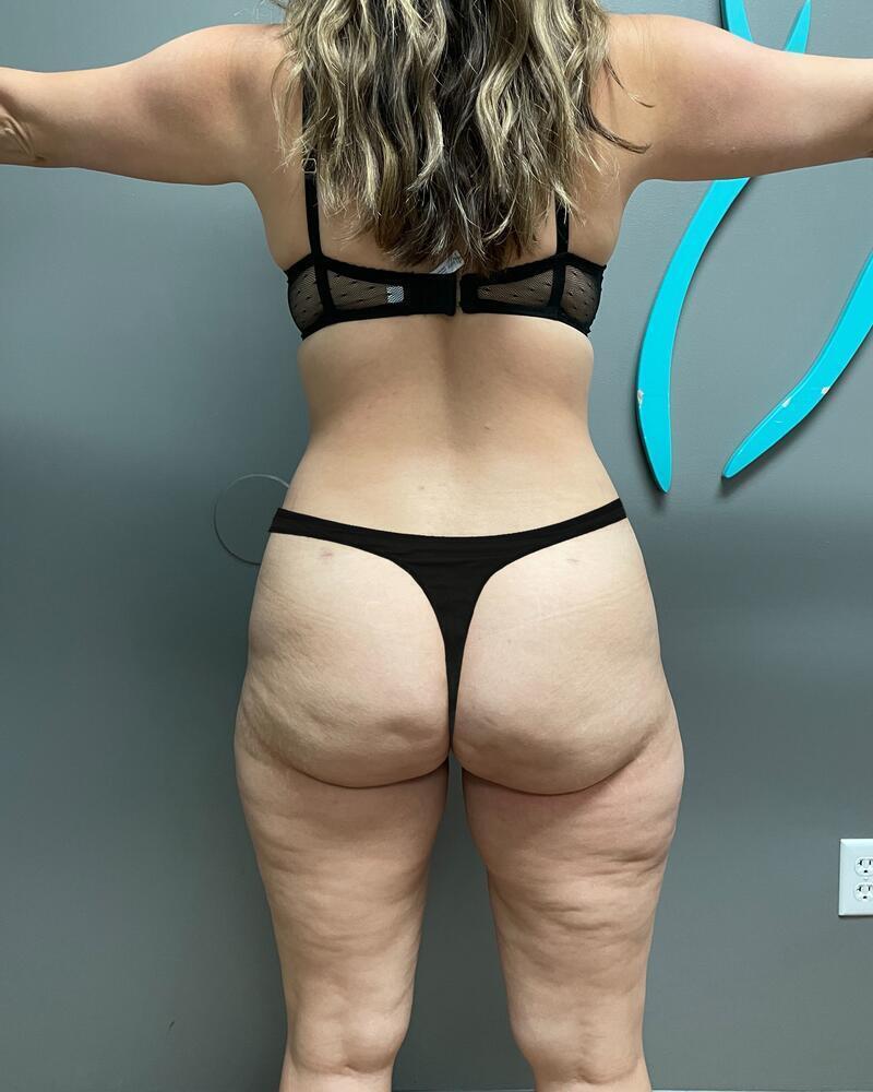 Liposuction Knees Before & After Image